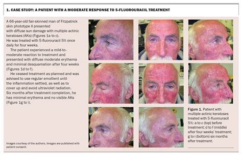 Actinic keratoses – a guide to treatment with 5-fluorouracil cream ...