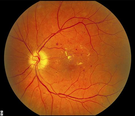 Diabetic Retinopathy: An Update on Treatment - The American Journal of ...