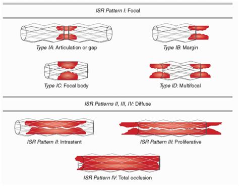 Restenosis | Thoracic Key