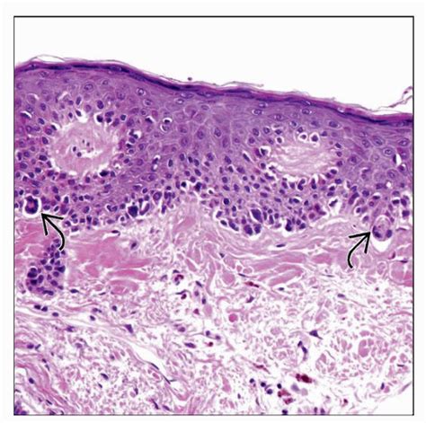 Melanoma In Situ, Lentigo Maligna Type | Basicmedical Key