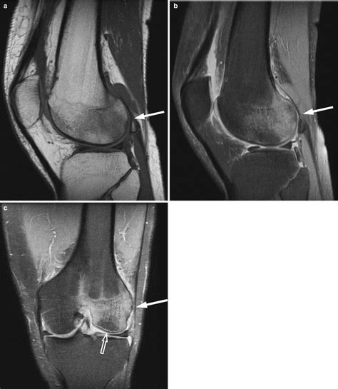 Bone Marrow Edema Syndrome