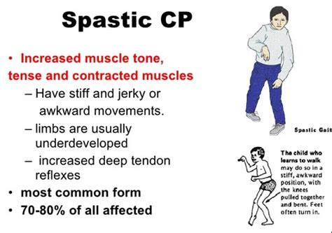 Spastic Cerebral Palsy - Cause, Symptoms, Treatment, Exercise