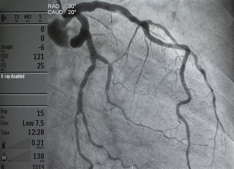 Markers to Predict CI-AKI in Patients With ACS Undergoing Coronary ...