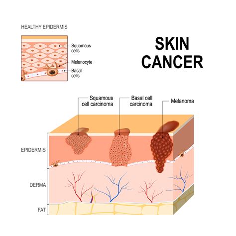 Skin Cancer Treatment Toms River & Manasquan NJ