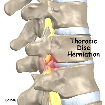 Thoracic Disc Herniation - Orthopedic Surgery, Algonquin, IL ...