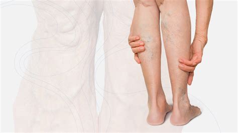 Chronic Venous Insufficiency: Symptoms, Causes, and Treatment