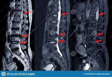 Bulging Disc Lumbar Spine MRI