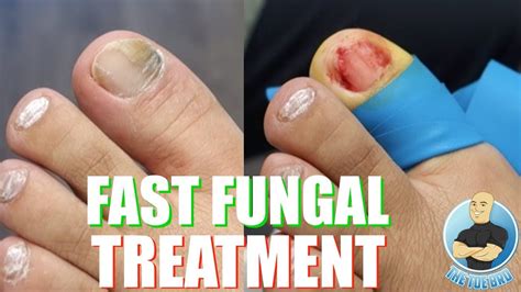 does toenail fungus look like - Toenail Fungus Treatment | Toenail ...