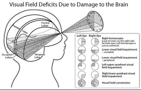 Frontiers | Impact of Cerebral Visual Impairments on Motor Skills ...