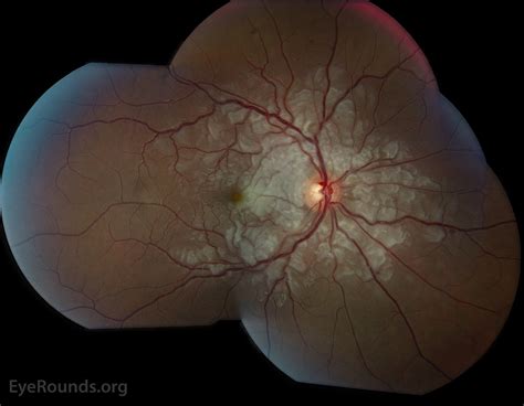 Purtscher Retinopathy