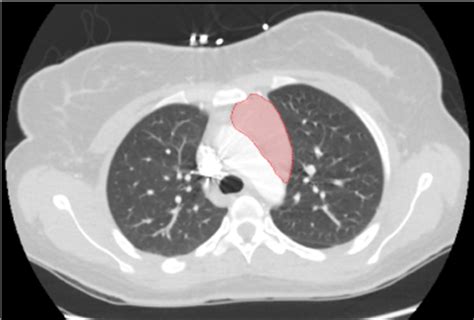 A rare complication of mediastinal mass biopsy