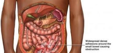 Paralytic Ileus Symptoms and Causes | Baby Health