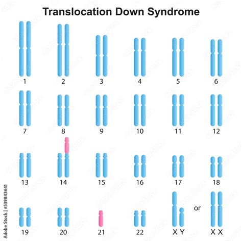 Scientific Designing of Robertsonian Translocation Down Syndrome ...