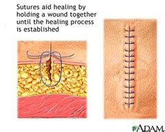 Surgery 4 - WOUNDS (p8-9) Flashcards | Quizlet