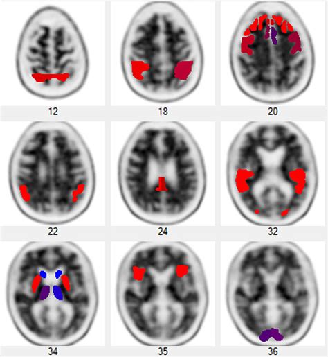 Amyloid Pet Scan Of The Brain, Positive Photograph by Steven Needell ...