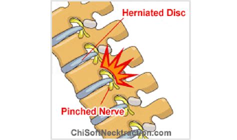 Pinched Nerve Treatment Without Surgery