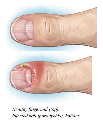 Fungal Nail Infection Know The Causes Symptoms Of It! By Niraj Jain ...