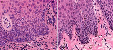 a High power view of a melanotic macule (biopsy from 2004) with typical ...