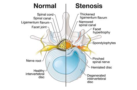 Lumbar Stenosis: Causes, Symptoms and Treatment Options for Narrowing ...