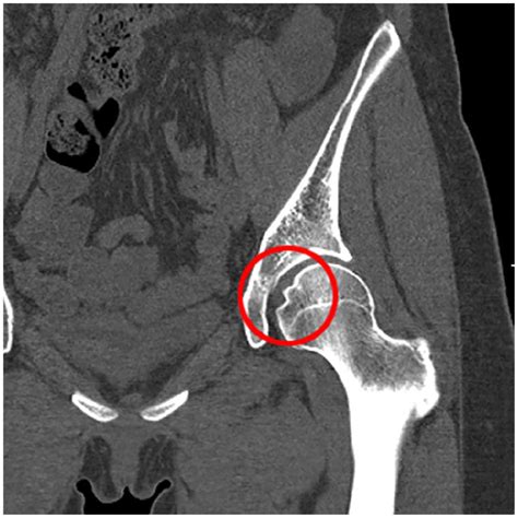 Subchondral Cyst