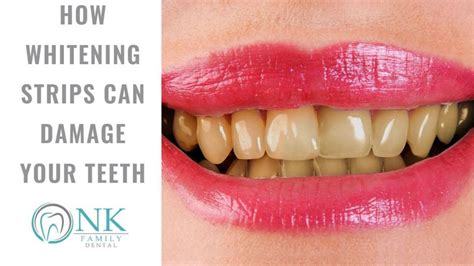 How Whitening Strips Can Damage Your Teeth - NK Family Dental