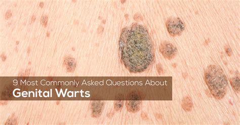 9 Most Commonly Asked Questions About Genital Warts – Marham