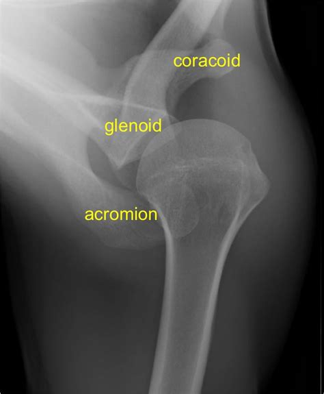 Scapula Anatomy Xray