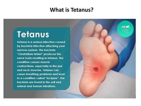 Clostridium Tetani Symptoms