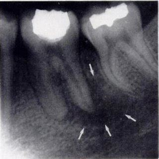 -Periapical abscess. lntraoral radiograph shows mandibular molar with ...