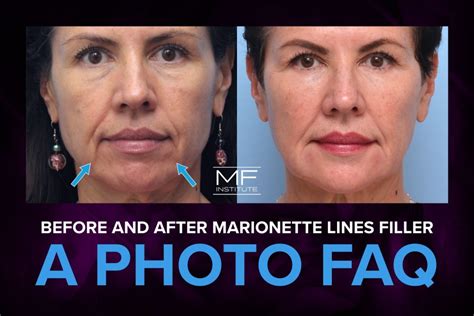 Before and After Marionette Lines Filler: A Photo FAQ | Mabrie Facial ...