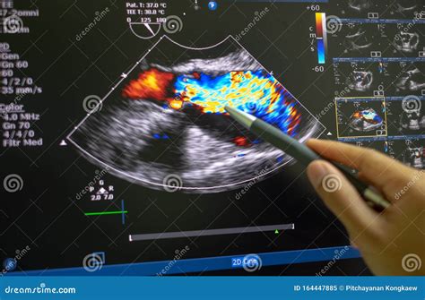 Echocardiography, Ultrasound Of The Heart. Normal Children`s Result Of ...