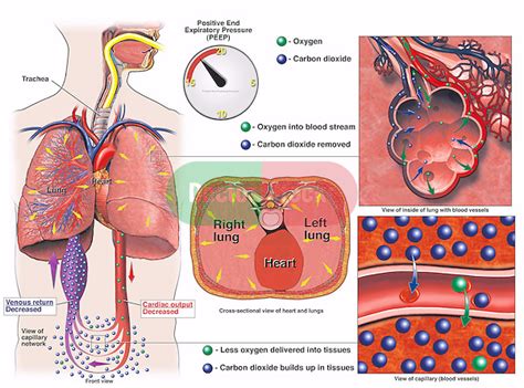 Circulatory System Impaired by PEEP Above 15 | Doctor Stock