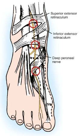 Deep Peroneal Nerve Entrapment - Foot & Ankle - Orthobullets.com Nerve ...