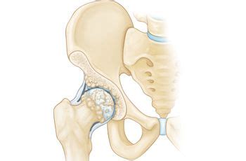 Osteoarthritis of the Hip Animation - OrthoInfo - AAOS