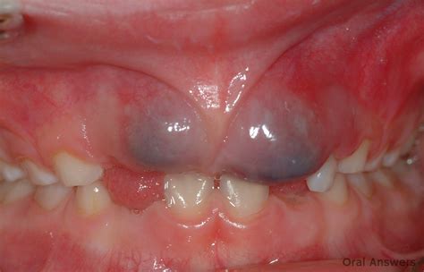 Eruption Cyst: Photos of a Purple Bump on the Gums | Oral Answers