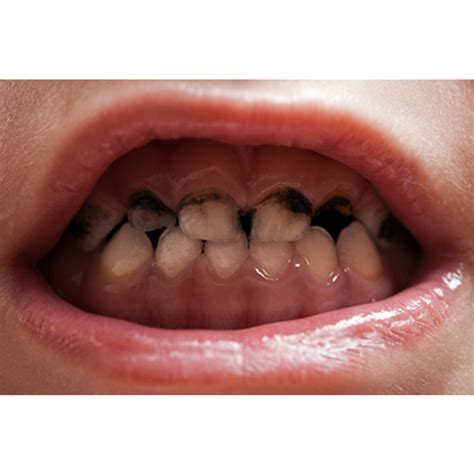 Signs of Tooth decay in children Symptoms Causes Treatment