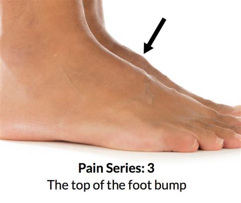 Foot bump on top of the foot | Consulting Footpain