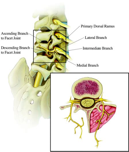 Lumbar Facet Syndrome - Physiopedia