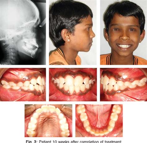 Figure 3 from Early Correction of Developing Anterior Crossbite with ...