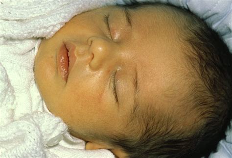 What Is Jaundice? | Healthcare-Online