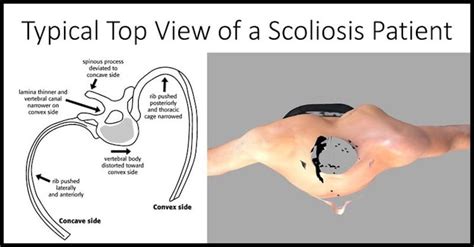 Structural Scoliosis vs Nonstructural Scoliosis