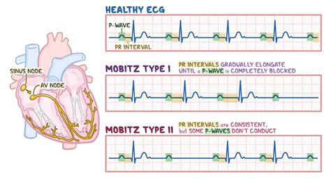 Second Degree Heart Block - How Heart Starts Skipping Beats