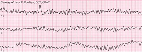 Ventricular Fibrillation ECG Criteria and Review | LearntheHeart.com