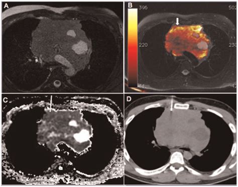 A 35-year-old man with a large mass in the anterior mediastinum. The ...