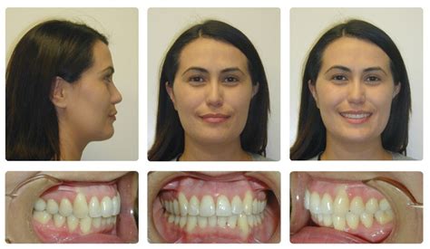 Deep Overbite Before And After | Braces before and after, Misaligned ...