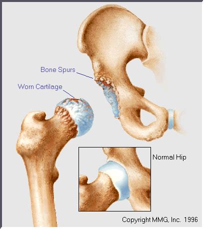 Osteoarthritis of the Hip Specialist | 🩺Singapore Sports & Orthopaedic ...