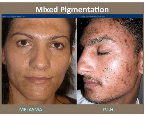 Melasma Treatment Plano - Hyperpigmentation Treatment Frisco