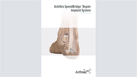 Arthrex - Achilles SpeedBridge™ Repair