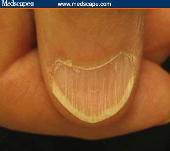 Examining the Fingernails When Evaluating Presenting Symptoms in ...