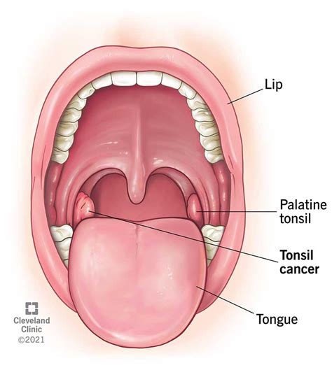 Tonsil Cancer: Symptoms, Signs & Causes